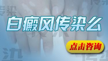 白癜风的传染性是真的吗?