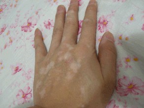 手部白癜风的早期症状是什么呢