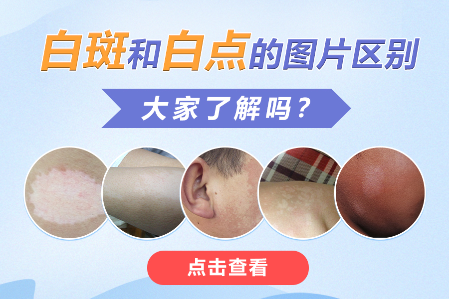 郑州西京白癜风医院在线咨询 郑州西京白癜风医院在线咨询