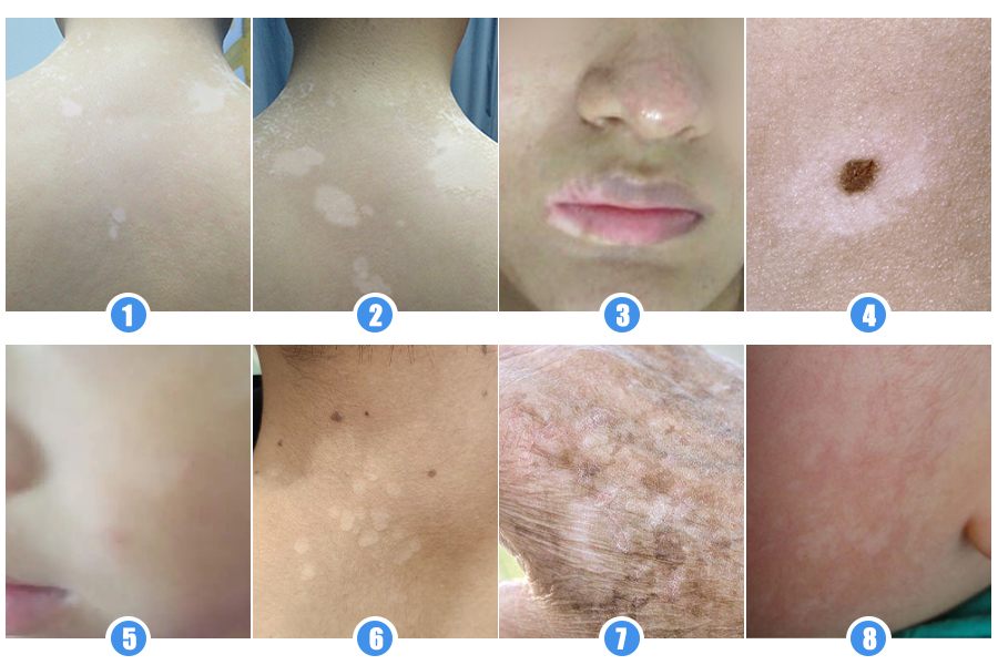 郑州西京白癜风医院 郑州西京白癜风医院